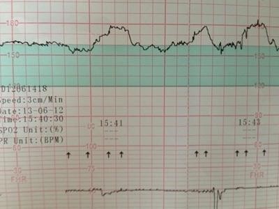 孕晚期必看一学就会教你秒懂胎心监护单