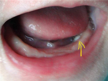 新生儿长马牙子图片图片