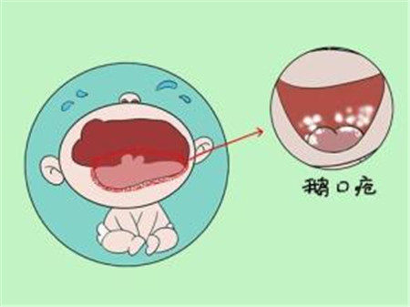 鹅口疮最佳治疗方法