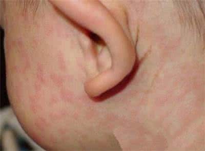 小儿风疹的症状和治疗宝宝风疹的表现有哪些