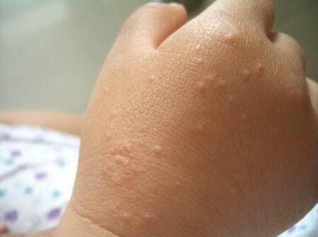 宝宝尘螨过敏的症状四 可疑物品会有螨虫